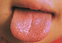 イチゴ舌　イメージ
